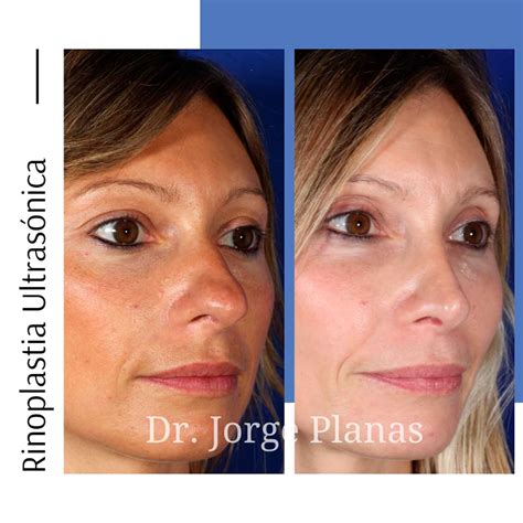 Rinoplastia Ultrasónica Antes Y Después Resultados Espectaculares