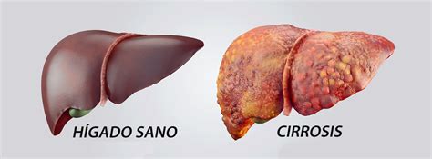 Cirrosis Síntomas Causas Y Tratamientos Canalsalud