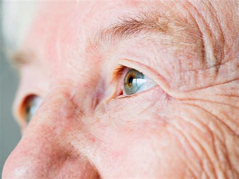 Qué es el glaucoma y cómo prevenirlo Opivision