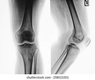 Digital Xray Knee Dog Severe Osteoarthritis Stock Photo (Edit Now ...