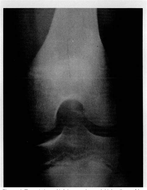 Figure 1 From Osteochondral Avulsion Fracture Of Femoral Insertion Of