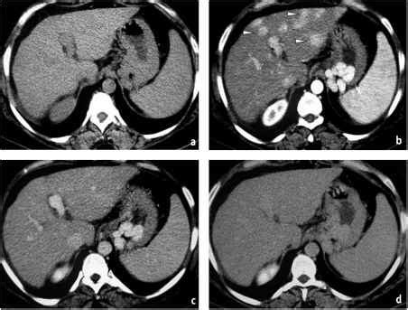 Images Anatomy For Mri Liver Contrast - MRI of the Liver