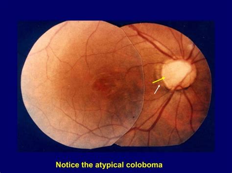 Optic Disc Pit Pathogenesis And Management Ppt