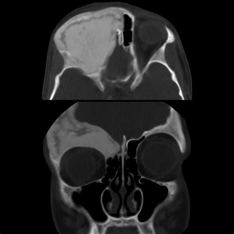 Fibrous Dysplasia Pacs