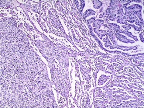 RCC Histology Unclassified - KCCure