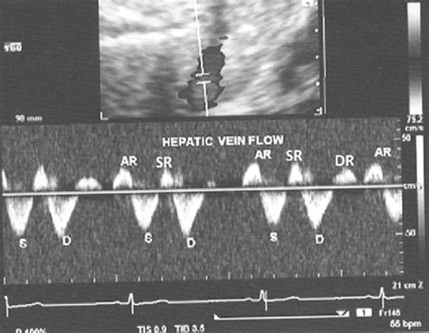 Hepatic Vein Doppler From A Case Of Pericardial Constriction Showing