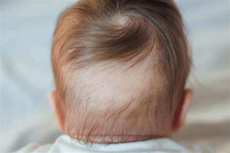 Baby Hair Loss: A Guide for New Parents - LittleOneMag