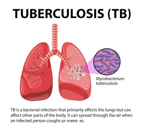 Infografía de la anatomía humana del pulmón con tuberculosis Vector