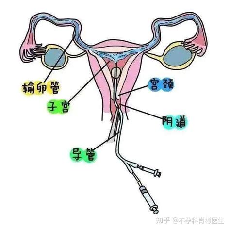 输卵管通水后为什么没有怀孕通水和造影哪个好 知乎