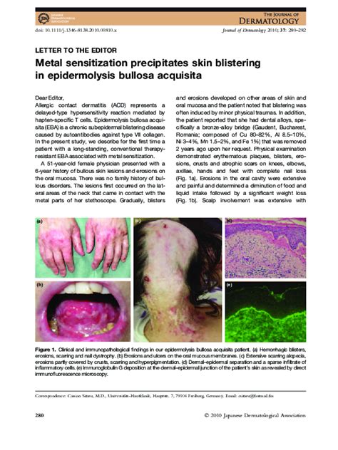 Epidermolysis Bullosa Acquisita Histopathology