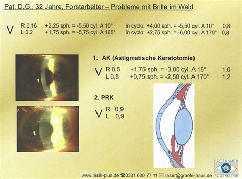 Lasik Oder Linsen Sehen Ohne Brille