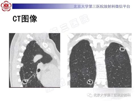 【ppt】肺类风湿结节 影像ppt