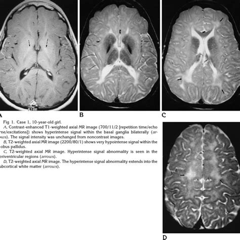 Case Year Old Girl A Contrast Enhanced T Weighted Axial Mr