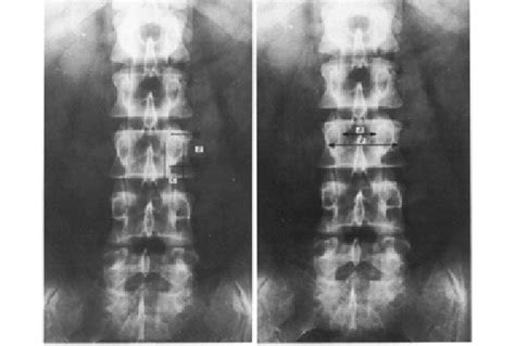 Plain X Ray Of Lumbar Spine Antero Posterior View Left Panel