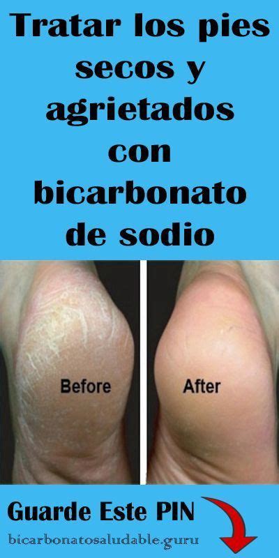 Tratar Los Pies Secos Y Agrietados Con Bicarbonato De Sodio Curar Los