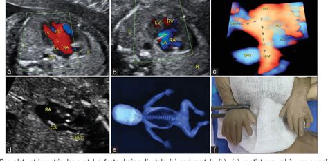 Figure 1 From Prenatal Diagnosis Of Ellisvan Creveld Syndrome By