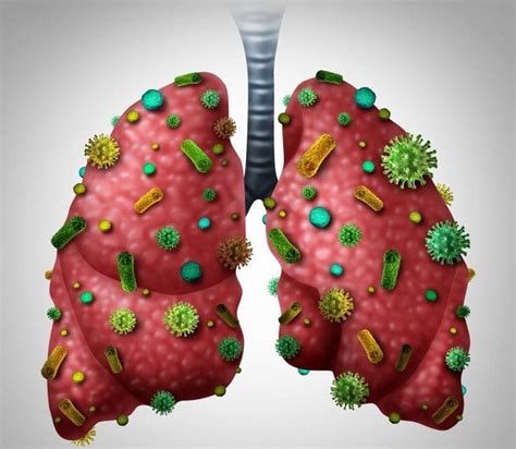 Pneumonia O Que Causas Sintomas E Tratamento Dicas De Muscula O