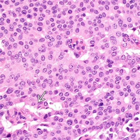 Well Differentiated Neuroendocrine Tumor Ampulla Basicmedical Key