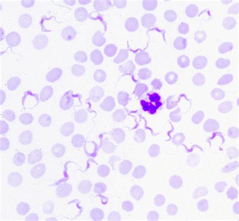 Trypanosomiasis African Disease Images Cfsph