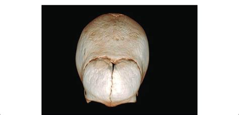 Multiplanar Reconstruction Computerized Tomography Obtained For Download Scientific Diagram