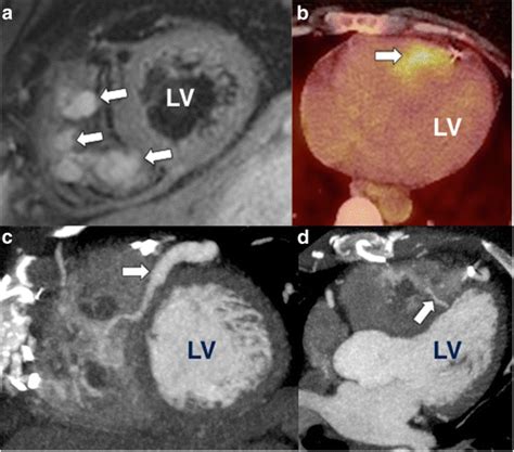 Multi Modality Imaging For Diagnosis Of Ventricular Hemangioma A