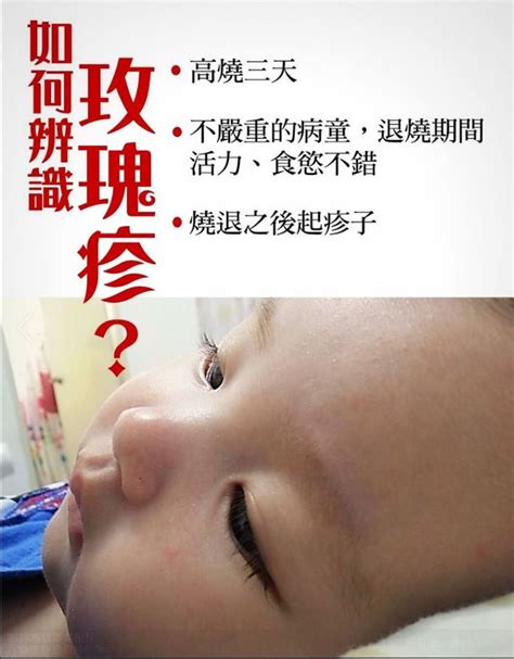 寶寶發燒別慌教你認識玫瑰疹 德芳保健藥妝