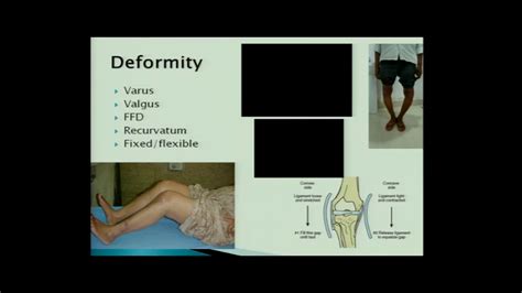 Patient Selection Pre Op Planning In Tka Dr Ramakant Kumar Youtube