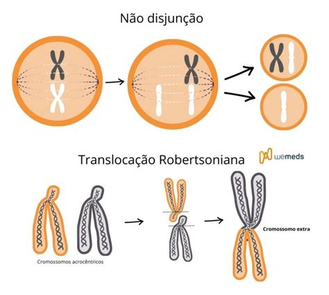 Síndrome de Patau saiba mais sobre a trissomia do cromossomo 13