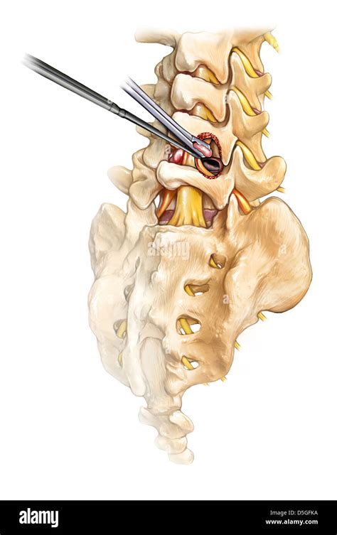 Laminectomy Discectomy Hi Res Stock Photography And Images Alamy