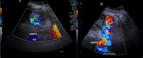 Nutcracker Syndrome Challenges In Diagnosis And Surgical Treatment