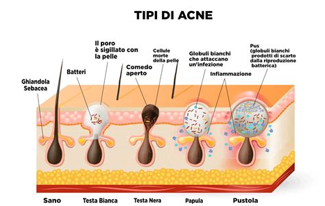 Acne Come Si Manifesta La Diagnosi E Come Si Cura