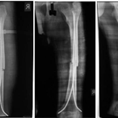 B Immediate Post Op X Ray C D X Ray After 8 Weeks Of Operation