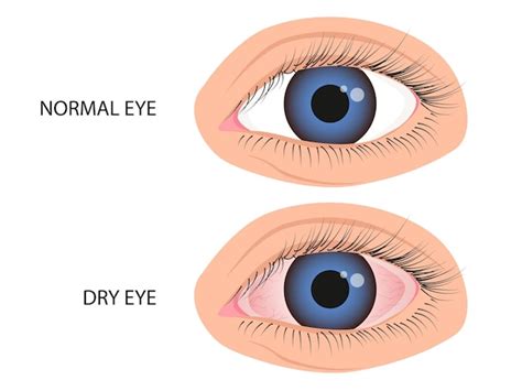 인간의 눈은 건강하고 건조합니다 각막염 알레르기 결막염 포도막염의 증상 프리미엄 벡터