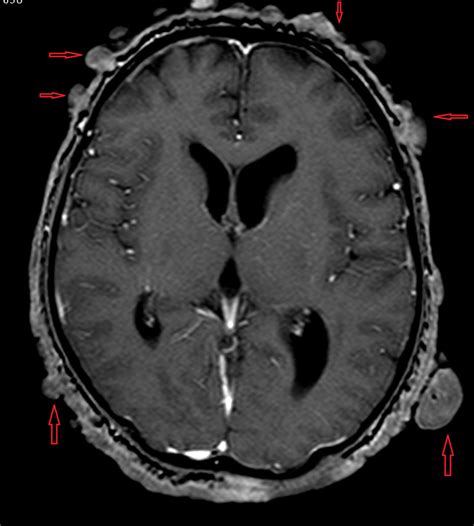 A Rare Case Of Diffuse Neurofibroma Of The Scalp With Destructive