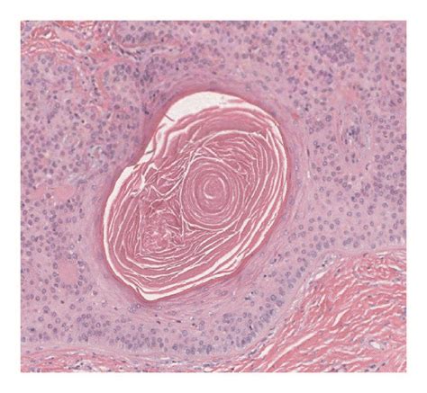 Higher power (20x) shows a keratocyst with no visible granular layer ...