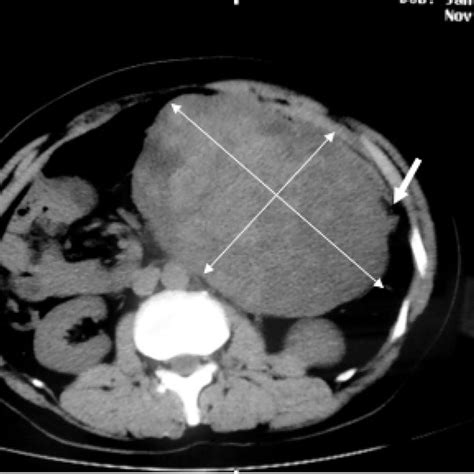 A Well Circumscribed Lesion With Smooth External Surface Measuring