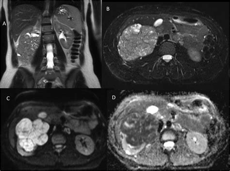 Adult Wilms Tumor An Unusual Case Report With Dedicated Literature