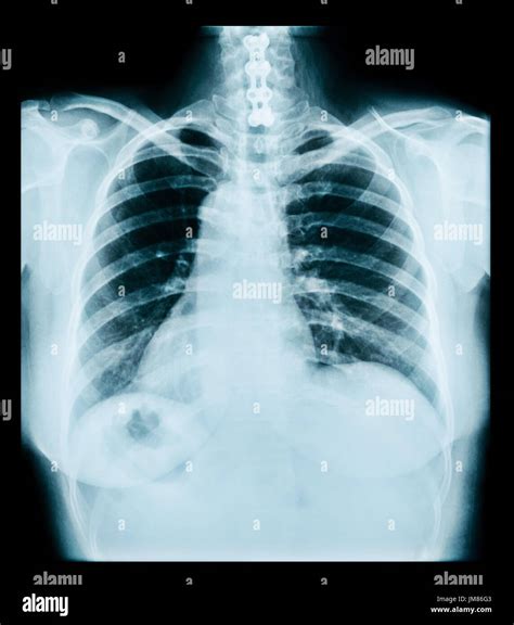 Radiografia Del Torace Immagini E Fotografie Stock Ad Alta Risoluzione