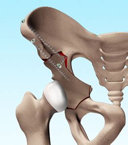 Periacetabular Osteotomy Park City, UT | Hip Dysplasia Salt Lake City, UT