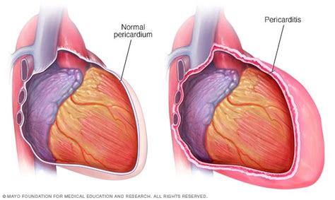 Pericarditis Disease Reference Guide Drugs