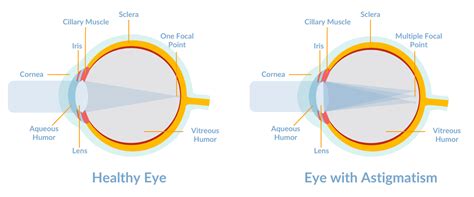 Astigmatism Causes Types Symptoms Treatment Vision Direct Au