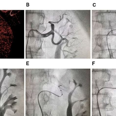 Angiography And Denervation Of The Right Renal Artery A Download Scientific Diagram