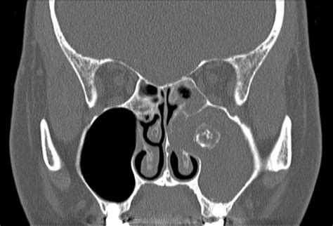 Chronic Purulent Nasal Discharge The Bmj