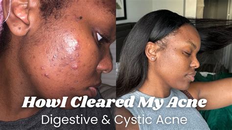 How I Cleared My Acne Digestive And Cystic Acne Youtube