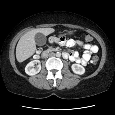 Normal CT Abdomen Radiology Case Radiopaedia Org