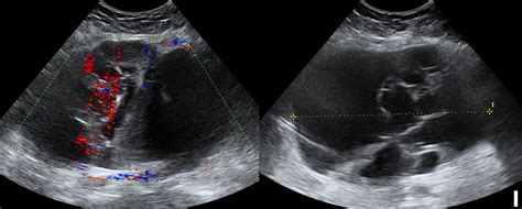 Adnexal Masses Incidental