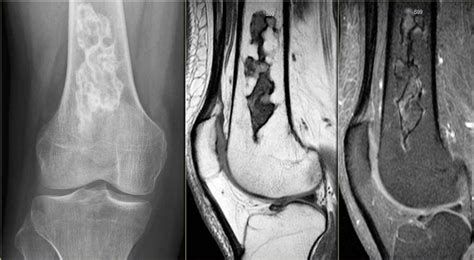 The Radiology Assistant Sclerotic Bone Tumors