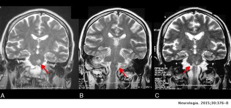 Lacunar Infarct Mri