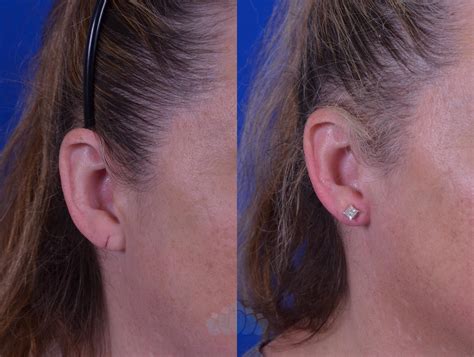 Earlobe Repair Before And After Pictures Case Charlotte Nc