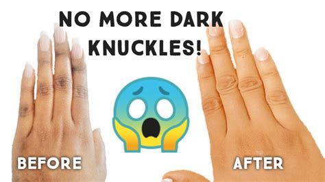 Unbelievable Whiten Dark Knuckles In Just Days Deedee Aquad